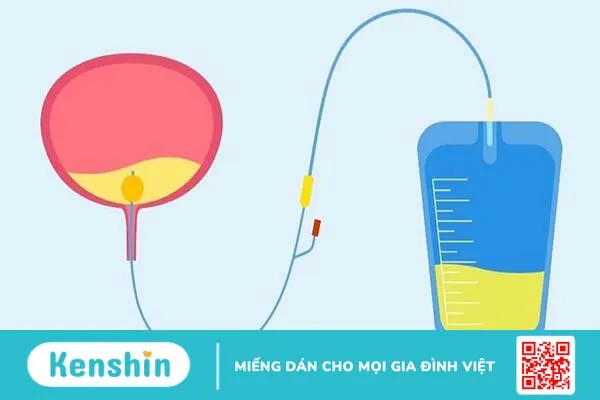 Thời gian lưu sonde tiểu tối đa là bao lâu? 2