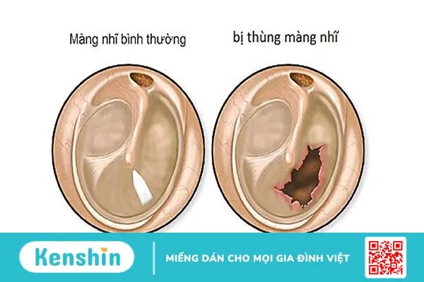 Thủng màng nhĩ có bị điếc không? Các phương pháp điều trị 1