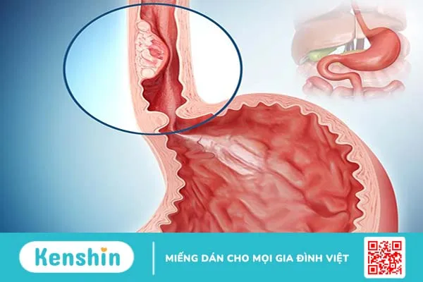 Thủng thực quản rất nguy hiểm bạn có biết? -2