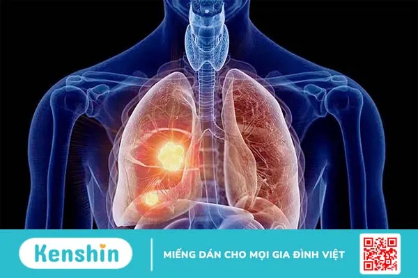 Thuốc lá và các bệnh do thuốc lá gây ra 2