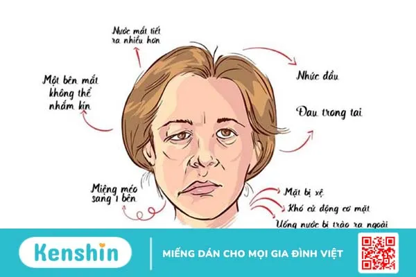 Bệnh liệt dây thần kinh số 7