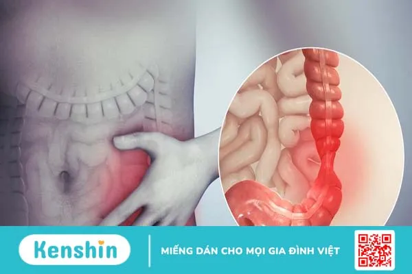 Mẹo chữa hội chứng ruột kích thích giúp người bệnh giảm triệu chứng -1