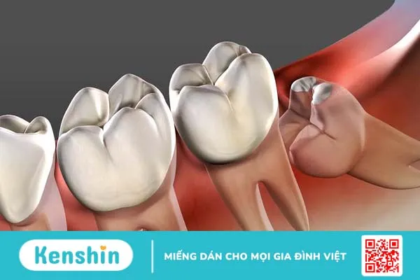 Tiểu phẫu răng khôn và những điều bạn cần lưu ý-1