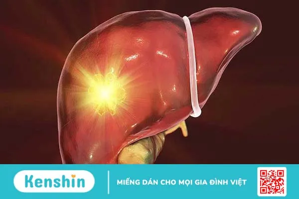 Tìm hiểu bệnh Adenoma gan và cách phòng ngừa hiệu quả 1