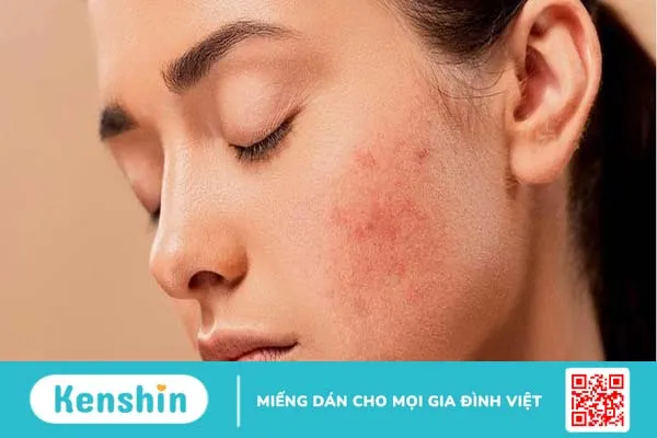 Tìm hiểu cách trị mụn bằng oxy già có tốt không Cần lưu ý gì khi thực hiện 1