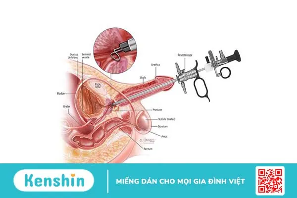 Tìm hiểu chi tiết về cắt đốt tuyến tiền liệt qua ngả niệu đạo 1