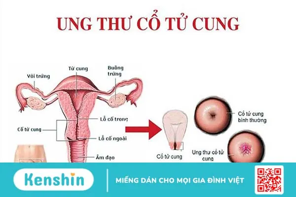 HPV là một trong những nguyên nhân gây ung thư cổ tử cung