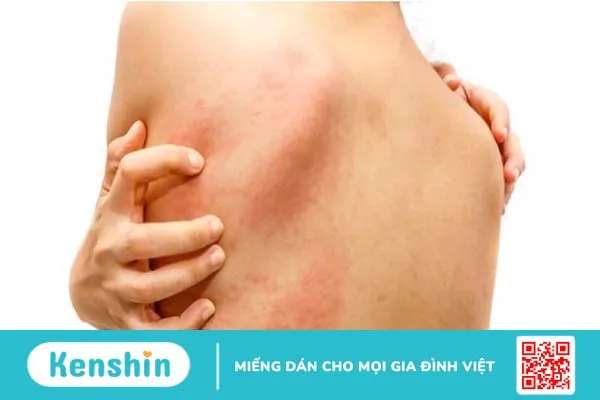 Mề đay sắc tố là gì? 3