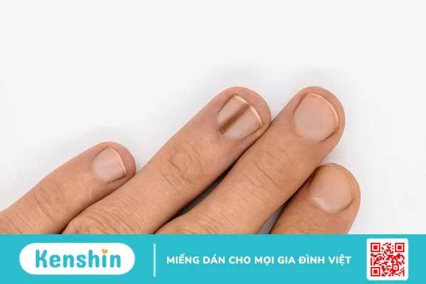 Tìm hiểu móng tay có sọc đen nhỏ là bệnh gì?