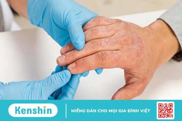 Tìm hiểu nguyên nhân và cách trị mụn nước hiệu quả 3