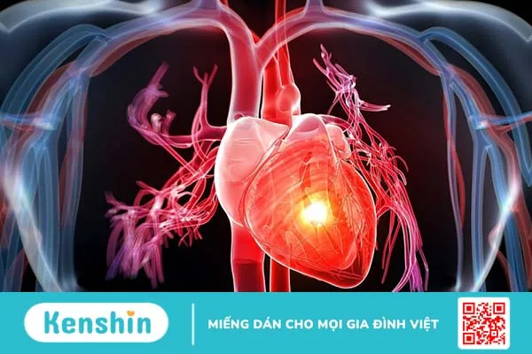 Tìm hiểu RCA là gì? RCA có ý nghĩa gì trong hệ thống tim mạch? 4