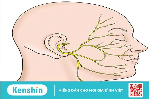 Tai biến méo miệng do liệt dây thần kinh số 7 2