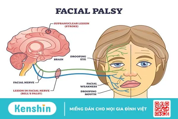 Tai biến méo miệng do liệt dây thần kinh số 7 3