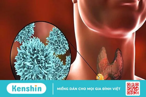 Thông tin bệnh ung thư tuyến giáp thể nang và cách điều trị 1