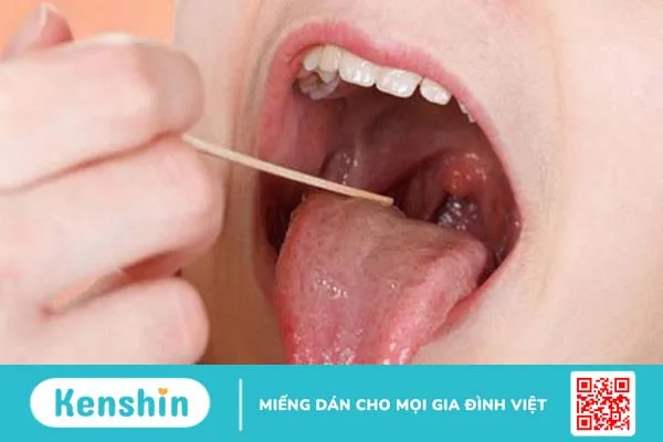 Tìm hiểu về bệnh viêm thanh thiệt là gì? Cách nhận biết và điều trị bệnh viêm thanh thiệt 2