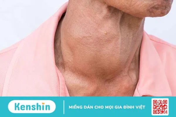 Tìm hiểu về bướu giáp và phân độ bướu giáp 2