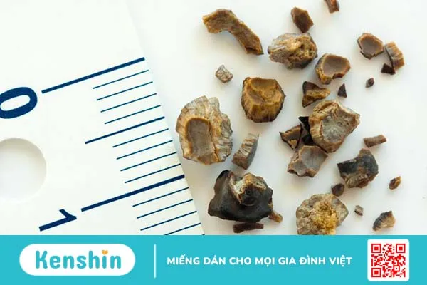 Tìm hiểu về các loại sỏi tiết niệu thường gặp 2