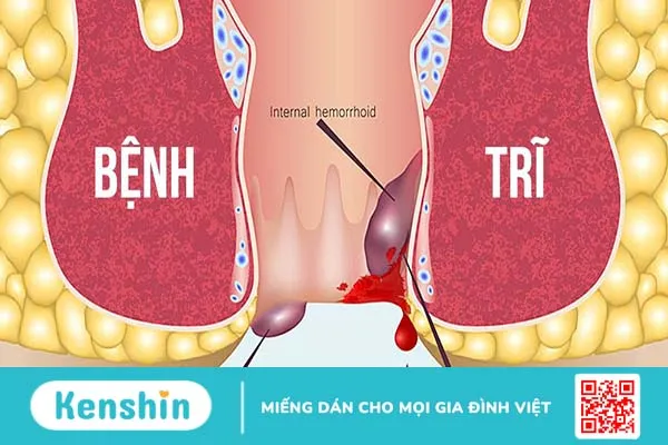 Tìm hiểu về các loại thuốc trị bệnh trĩ và những lưu ý khi sử dụng 1