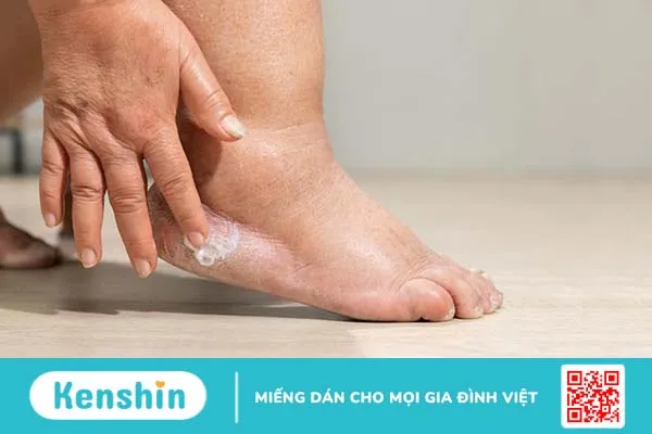 Tìm hiểu về các phân độ phù, nguyên nhân và cách điều trị 2