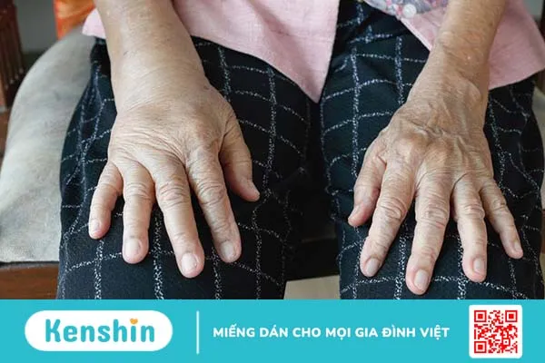 Tìm hiểu về các phân độ phù, nguyên nhân và cách điều trị 3