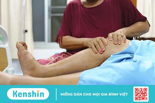 Tìm hiểu về các phân độ phù, nguyên nhân và cách điều trị 4