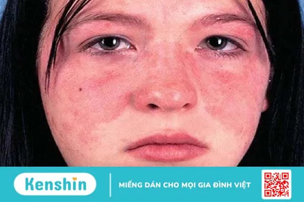 Tìm hiểu về lupus ban đỏ hệ thống mãn tính 1