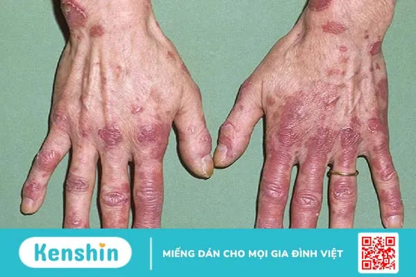 Lupus ban đỏ hệ thống là một bệnh mãn tính 2