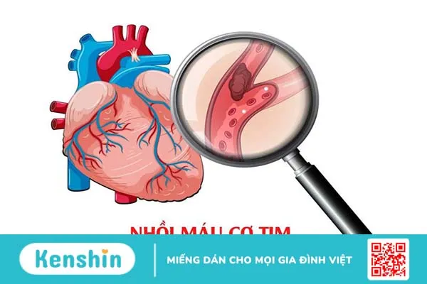 Tìm hiểu về phân độ Killip trong nhồi máu cơ tim cấp 1