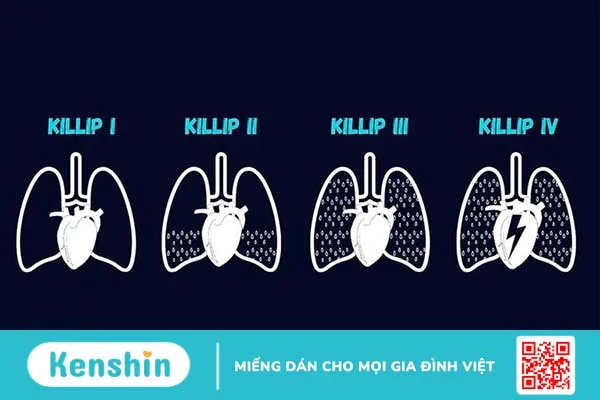 Tìm hiểu về phân độ Killip trong nhồi máu cơ tim cấp 2