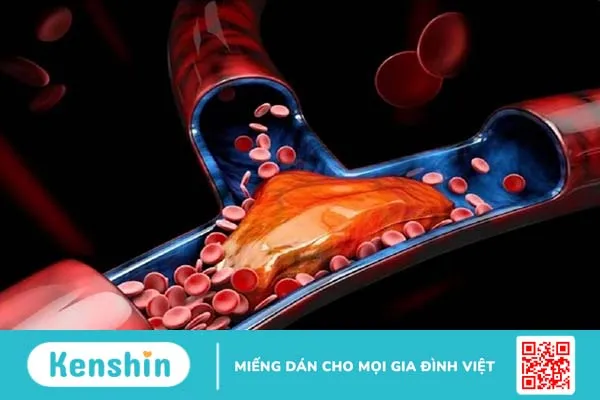 Tìm hiểu về phẫu thuật đường vào mạch máu chạy thận 3