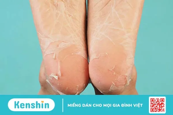 Tìm hiểu về phương pháp, cấp độ và các bước peel da body 2