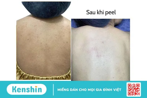 Tìm hiểu về phương pháp, cấp độ và các bước peel da body 3