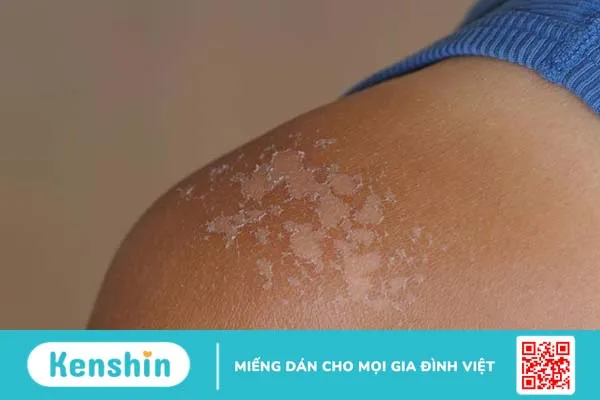 Tìm hiểu về phương pháp, cấp độ và các bước peel da body 4