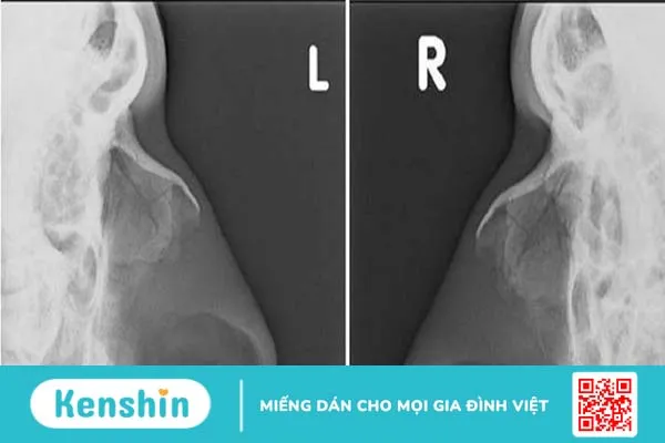 Tìm hiểu về phương pháp chụp X-quang Hirtz trong chẩn đoán viêm xoang 2