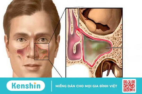 Tìm hiểu về phương pháp chụp X-quang Hirtz trong chẩn đoán viêm xoang 3