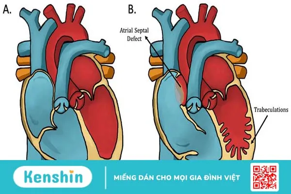 Tìm hiểu về tăng sinh cơ bè thất trái quá mức 2