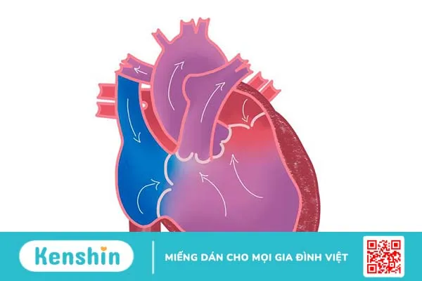 Tim một thất là gì? Nguyên nhân, triệu chứng, cách điều trị 1