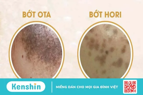 Tình trạng bớt sắc tố ở da: Phân loại, nguyên nhân và cách điều trị 2