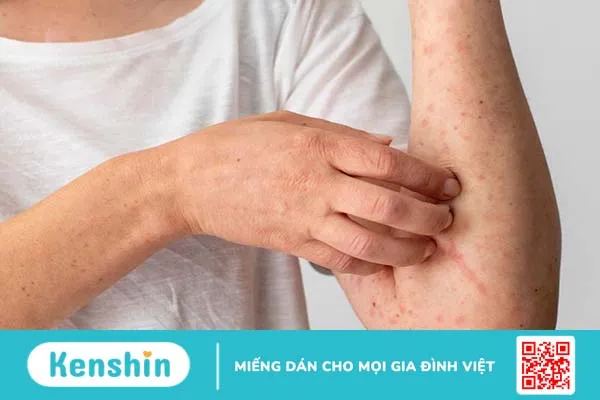 Tình trạng nổi hạch ở khuỷu tay cảnh báo bệnh gì? Phương pháp điều trị 1