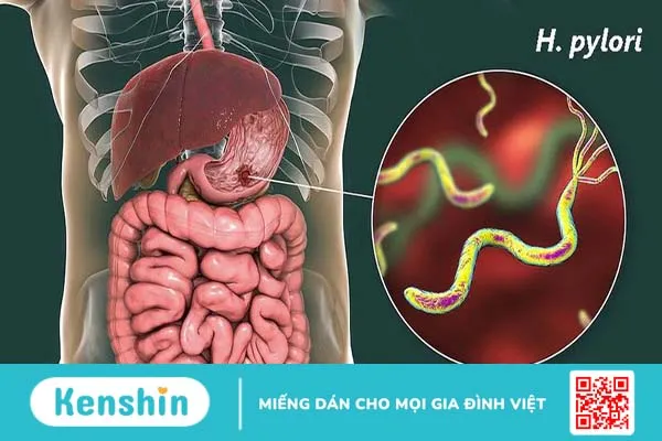 Tổng hợp các bệnh dạ dày thường gặp và dấu hiệu nhận biết 4