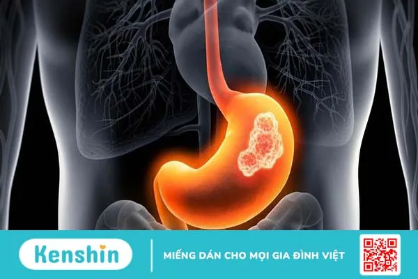 Tổng hợp các bệnh dạ dày thường gặp và dấu hiệu nhận biết 2