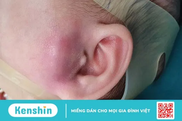 Tổng hợp những điều cần biết về nhọt ống tai ngoài 2