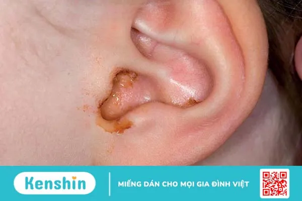 Tổng quan phác đồ điều trị viêm tai giữa mạn tính và cấp tính