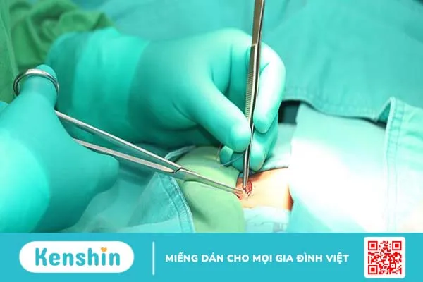 Tổng quan về phương pháp mổ nội soi điều trị thoát vị bẹn 4