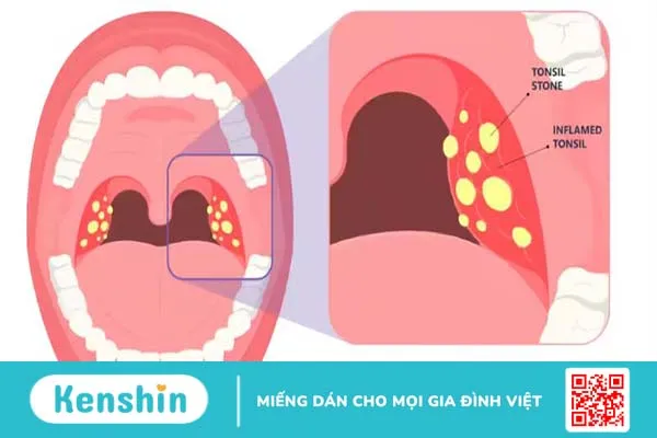 Bệnh tonsil stone là gì? 1