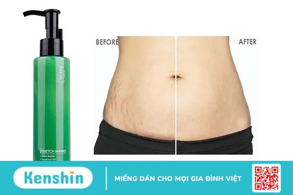 kem trị rạn da sau sinh hàn quốc 5