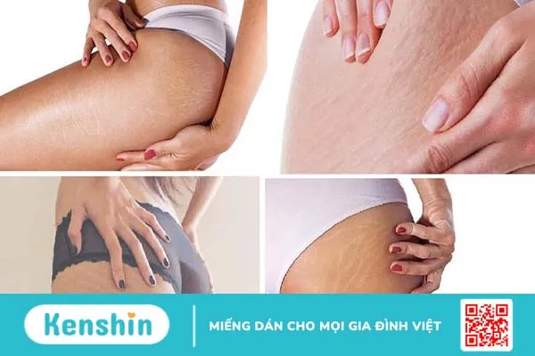 trị rạn da mông lâu năm 1