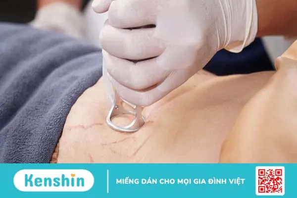 trị rạn da sau sinh bằng laser 1