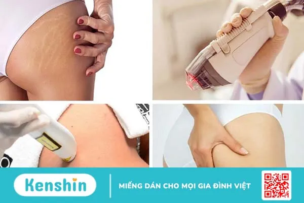 trị rạn da sau sinh bằng laser 2