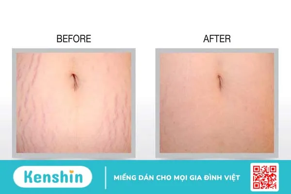 trị rạn da sau sinh bằng laser 3